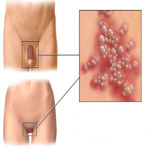 Virusi Human Papilloma