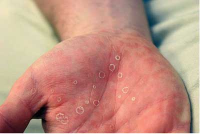 Secondary-Syphilis