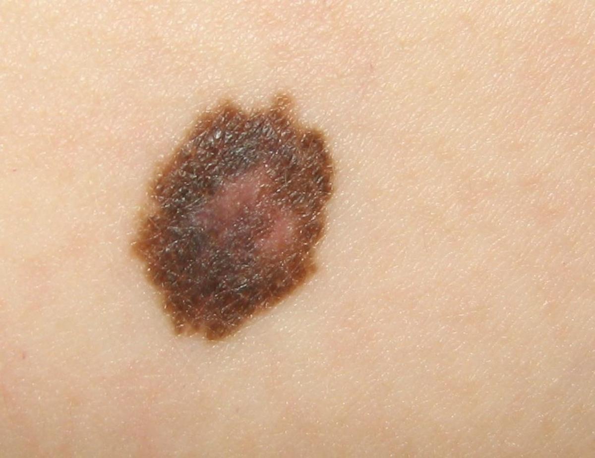 Melanomat malinje
